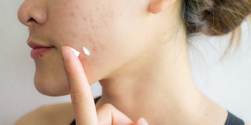 Three common acne myths