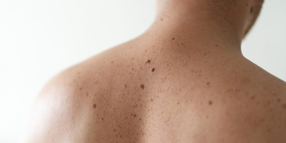 How to tell if a mole is cancerous