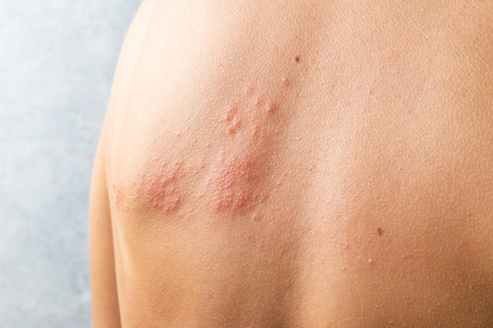 Can You Get Shingles Twice Within A Year