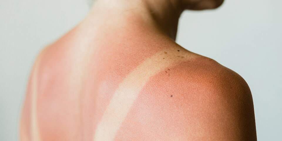 How to treat a bad sunburn