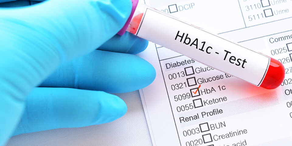 Does a high A1c test mean you have diabetes? Rachel Brown, MD, explained what it means if your A1c test result is too high and what to do next.