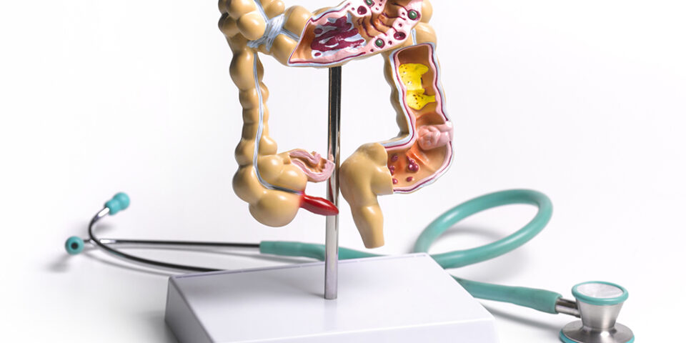 Gastroenterologist Anjani Jammula, MD, explained how colon cancer is different from rectal cancer and how these differences can impact your treatment and recovery.