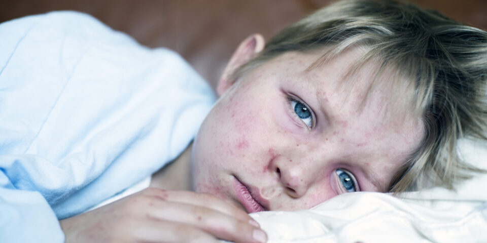 Measles is reemerging. Here's what you can do to protect your family.